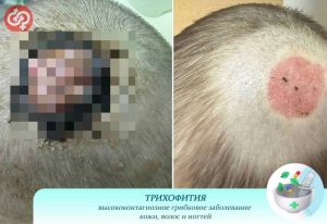 В Пензе врачи помогли малышу с редкой формой грибкового заболевания