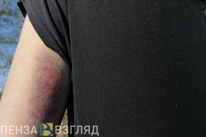 У жителя Каменского района после лечения в больнице отказала рука