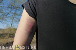 Пензенцам объяснили, какая травма считается производственной